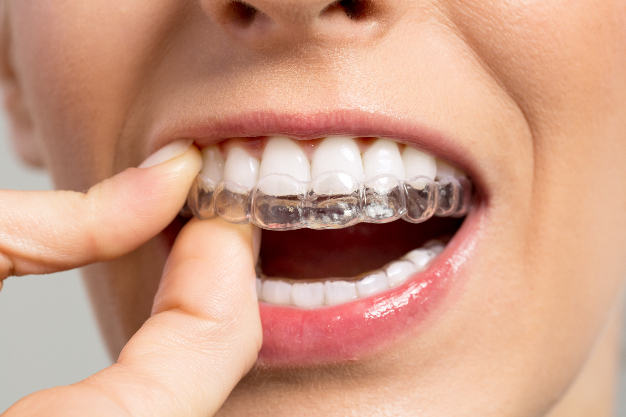 Nošnja Invisalign aparata je res skoraj neopazna